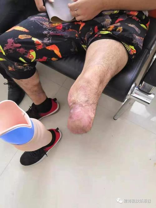 新澳门彩历史开奖记录走势图表和戴假肢3次登顶泰山与戴假肢3次登顶泰山会怎样